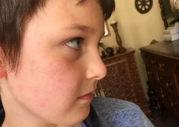 Leah Mead's son showing his bed bug bites