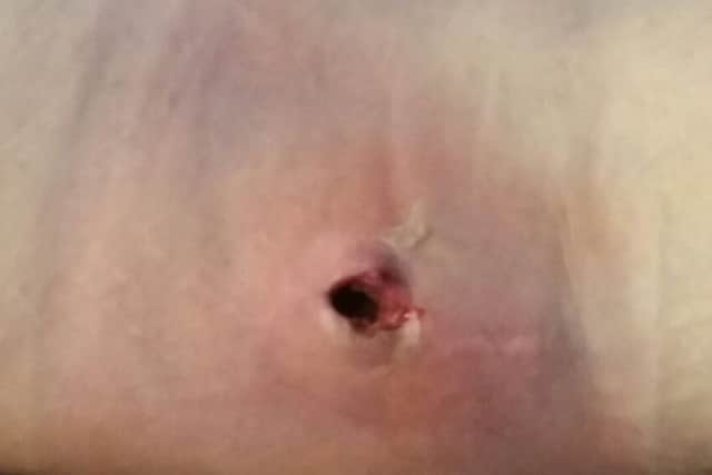 The infected spider bite on the back of Marie's leg