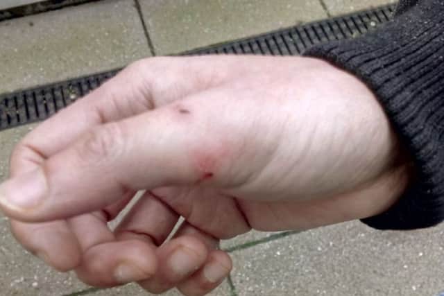 Abdul Gofur's injured thumb
