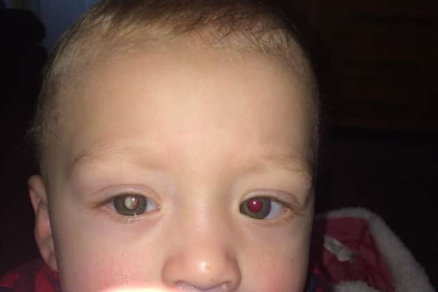 The photo of Jaxson, one, showing a white reflection in his eye which was then diagnosed as retinoblastoma