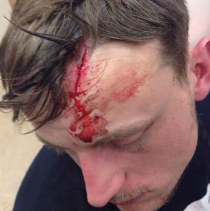 The wound on Arron Warren's head after he was hit with a police baton