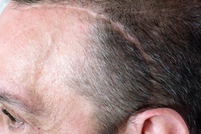Andy Carpenter's tumor scar