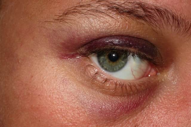 Injuries to a 25-year-old woman who was attacked outside the Blue Anchor pub