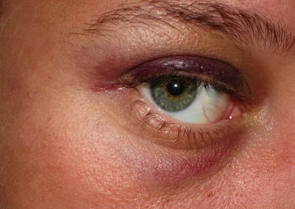 Injuries to a 25-year-old woman who was attacked outside the Blue Anchor pub