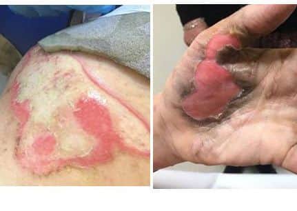Ellie suffered injuries to her thigh and hands during the incident. Picture: Ellie Petty/Facebook