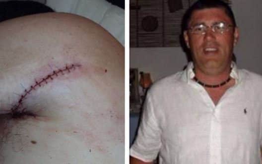 Andrew Budd (right) and the stitches he needed after the attack. Picture: Andrew Budd
