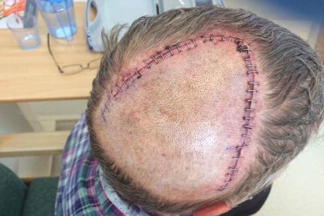 Andy Tudor after the operation