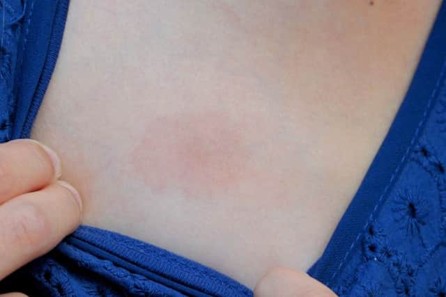 A spot caused by Lyme disease