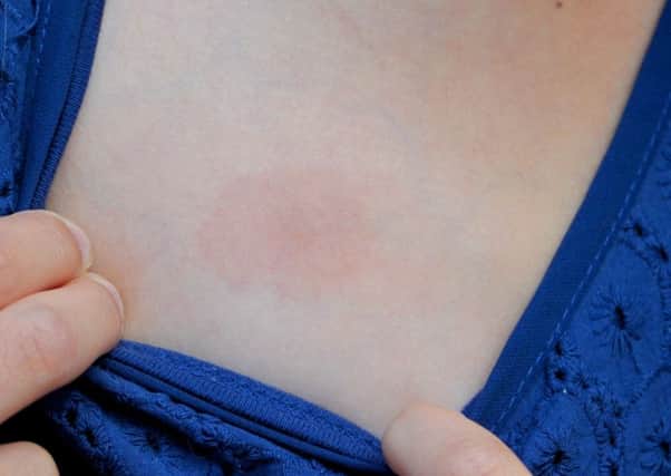 A spot caused by Lyme disease