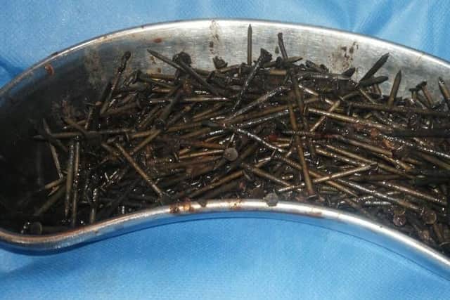 Some of the nails removed from the man's intestines